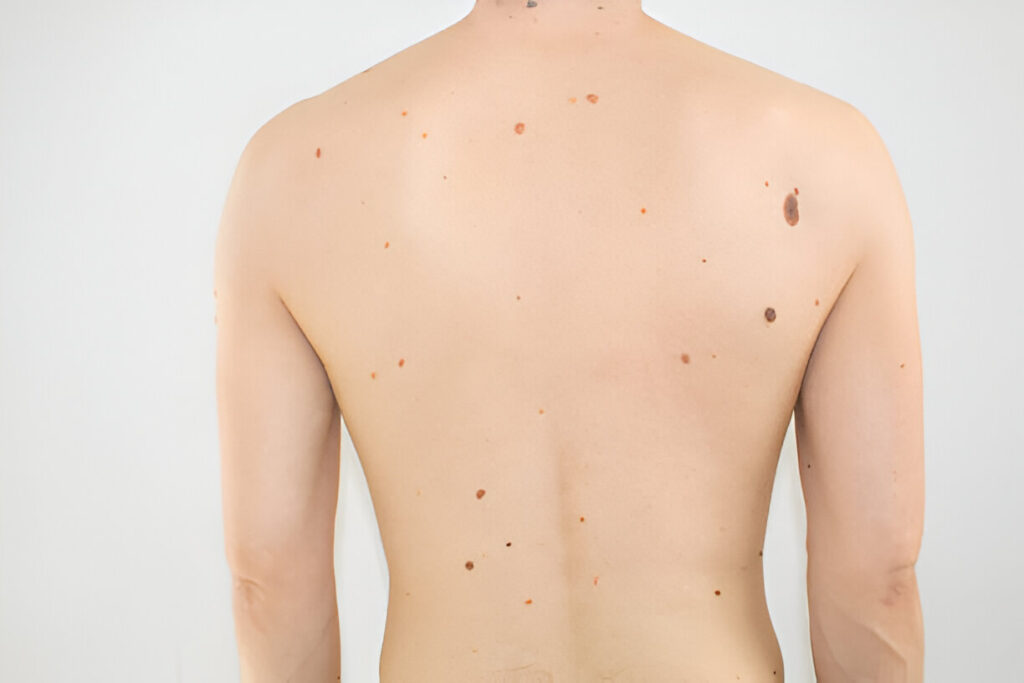 back nodular pimples