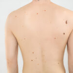 back nodular pimples